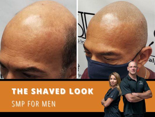 smp for men - hide balding problems with scalp micropigmentation