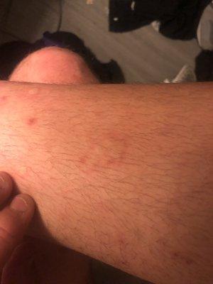 bed bug bites