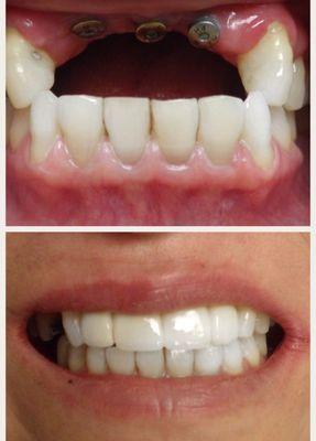 We are beyond excited to share yet another success story. This patient came to our office after wearing partial dentures most of her life. T