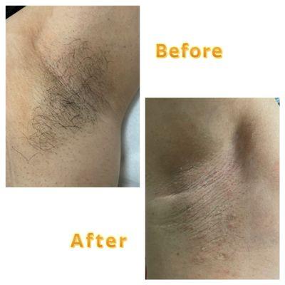 Underarm (axilla) wax