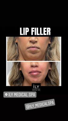 Lip Filler. Dermal Filler Juvederm, Versa, Restylane.