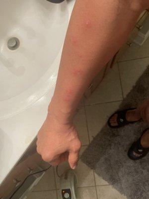 Left arm of Bed Bug Bites from hotel mattress