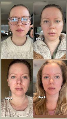 Days 1 - 4 side by side after Restalayne Kysse filler treatment (upper and lower lips)