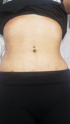 lipo-Cavitation After