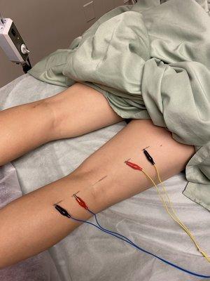 Electric acupuncture on calf and hamstring