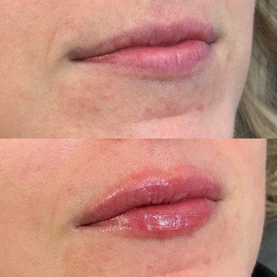 Before and After Lip Filler