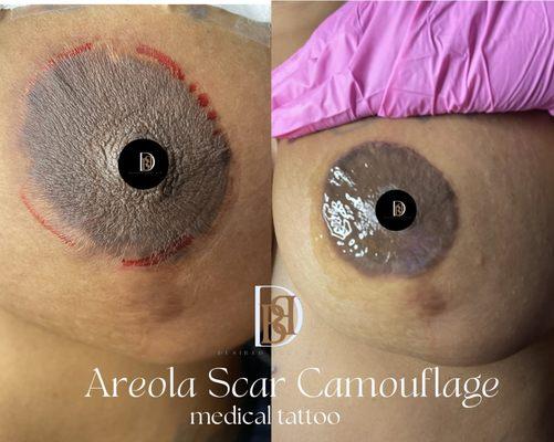 This client has areola scaring. She was treated with Scar camouflage.