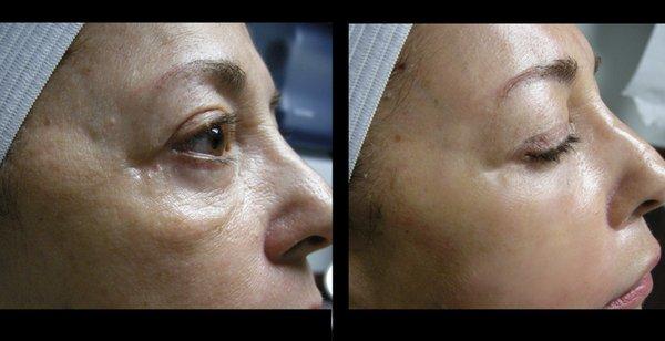 PRP Microneedling / Vampire Facelift