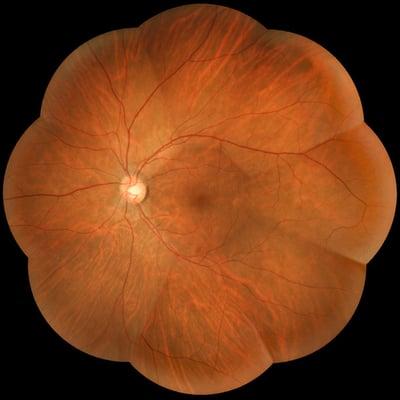 Retinal photography using multiple images stitched together