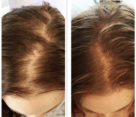 Hair grows treatment