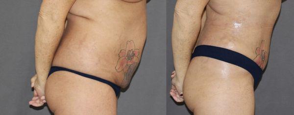 Stacey V Review:
Three months after abdominoplasty and liposuction. 
Success of healing and maintenance relies on various patient factors.