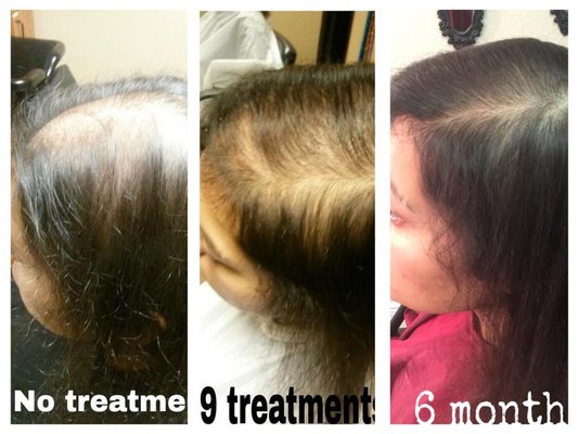 Reverse androgenetic alopecia we have the solution all natural treatments