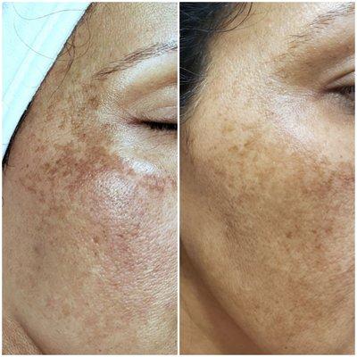 Pigmentation treatment