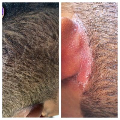 I started noticing a change to his scalp the next day after his hair cut. This picture is how much worse it got by day 3.