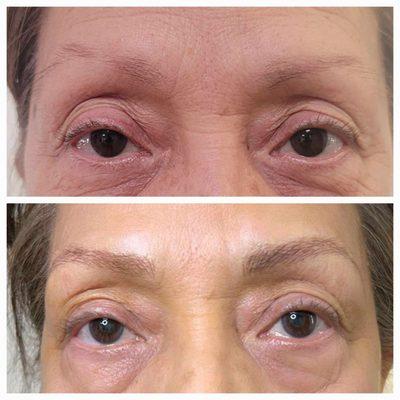 Microblading