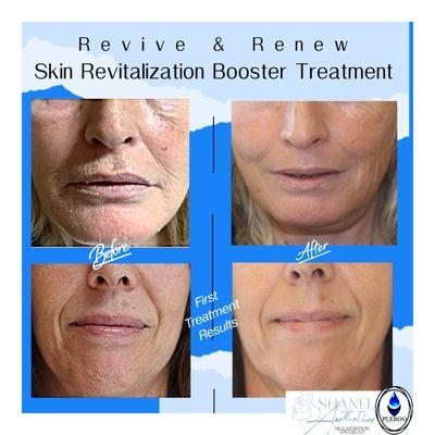 Skin Booster Treatments.