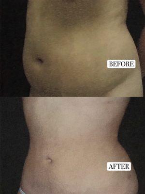 Liposuction of abdomen (**Procedure performed by Dr. Mirabadi. Individual results may vary.**)