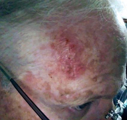 Cancer on my forehead - from exposure to silica caused by Mills failure to disclose the existence of silica on the property.