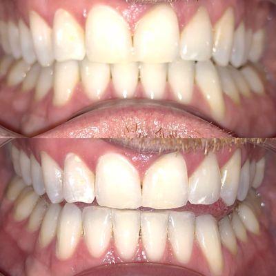 Teeth bleaching service from Tias Esthetics