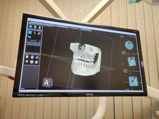 Image of my jaw and teeth after getting a CT Scan