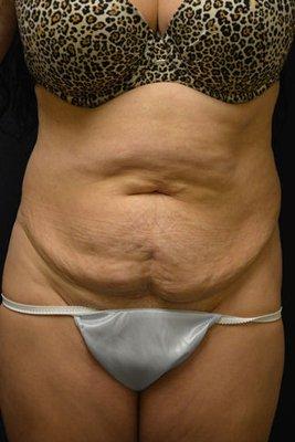 #5850 ABDOMINOPLASTY - 58 YEAR OLD, PRE-OP