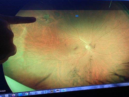 In the photo of my eye Dr. Bream points to the tear causing bleeding - the dark tendrils of blood. Her response matters!