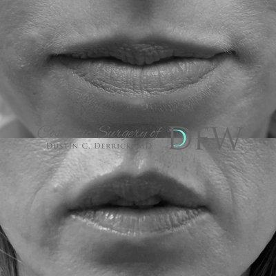 Lip filler results by Dr. D