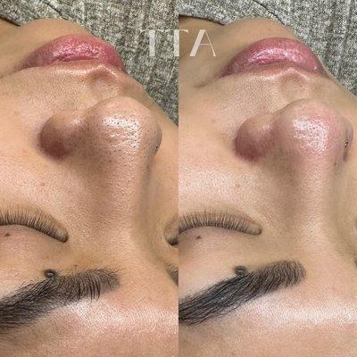 Results of a deep pore cleanse with The Golden Glow facial