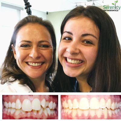 Braces before and after