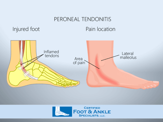 Peroneal Tendonitis Treatment