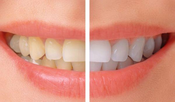 Teeth Whitening Services