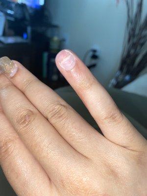 Nail completely broken and infected