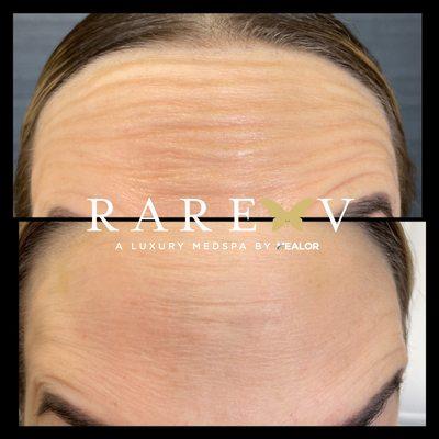 RAREV Botox Results.