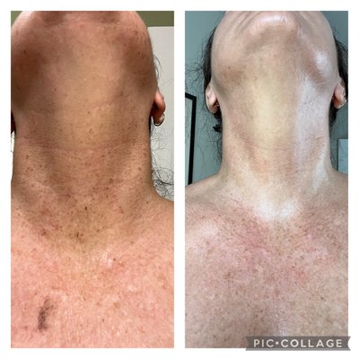 Results from one BBL treatment on my neck and one spot on my chest. I'll go back for the rest of my chest. SO HAPPY with the results!!!