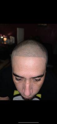 Finished- Hairline micro pigmentation