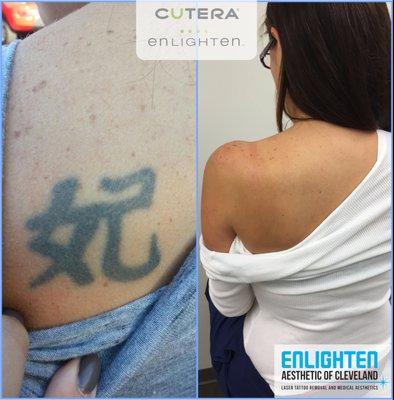 Enlighten Laser Tattoo Removal.