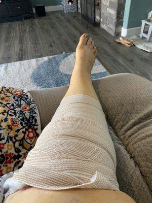 Torn meniscus and stem cell surgery