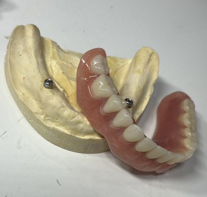 Denture over 2 locator attachments