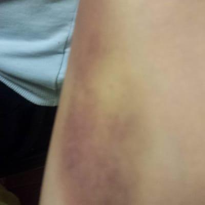 The nurse kept on poking to get my blood. After three days, this bruise formed and I can't even lift heavy objects.