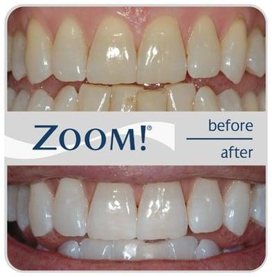 in office Zoom! whitening available