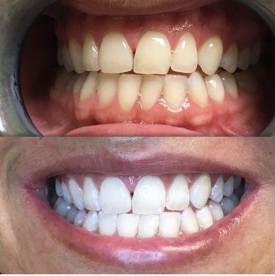 Teeth Whitening Results