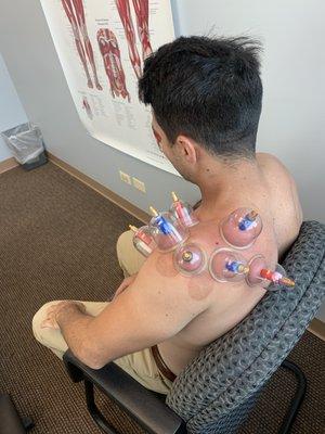 Cupping can help alleviate old injuries