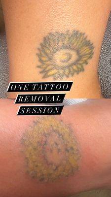 Laser Tattoo Removal one session with great results