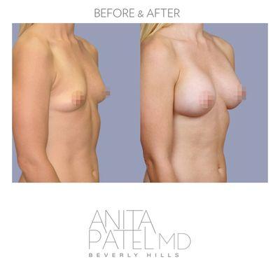 Breast Augmentation