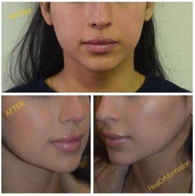 Before and After of Buccal Fat Removal