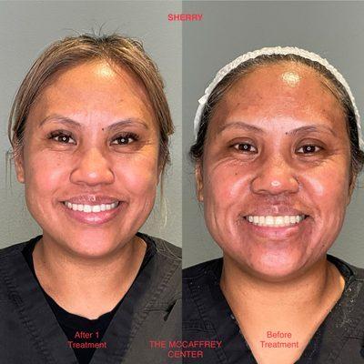 Opus Skin Resurfacing 
Before & After