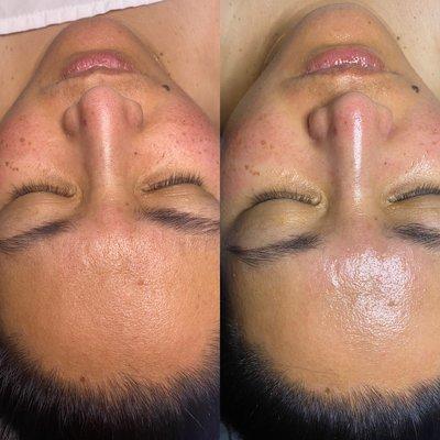 Before/after facial