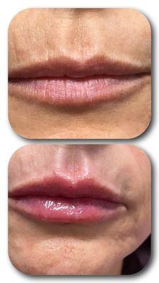 Turning Back Time: Witness the miraculous lip filler transformation that rejuvenated this beautiful patient, making her look years younger.