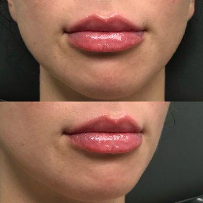 1 syringe of Kysse Lip Filler