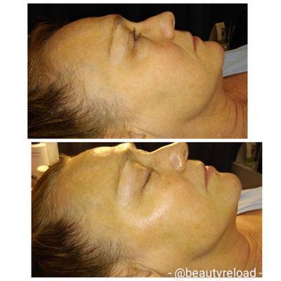 Dermaplaning Facial $60